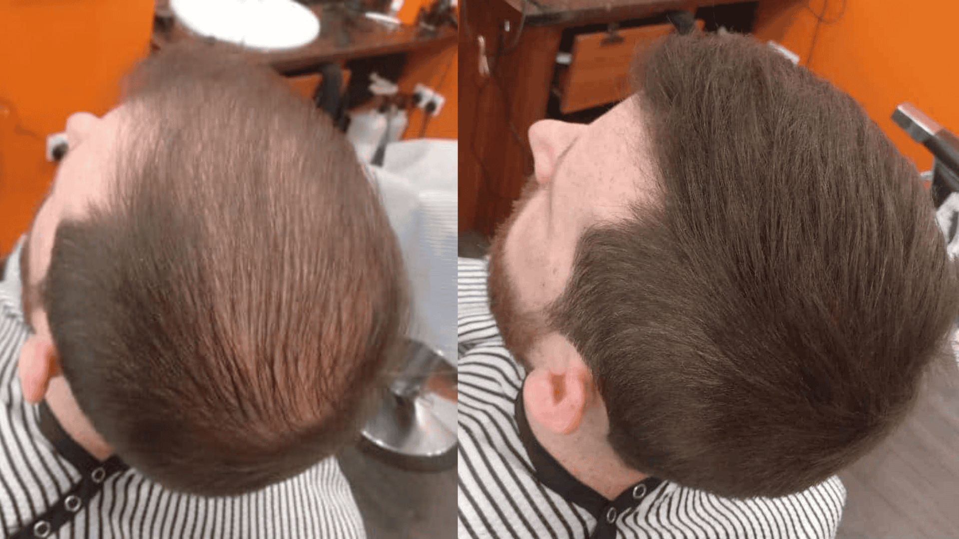 Why Do People Choose Hair Fibers Instead Of Surgical Procedures?